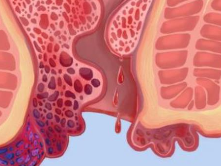 2025 独家盘点！痔疮药排名，消肉球、止血效果显著的全收录